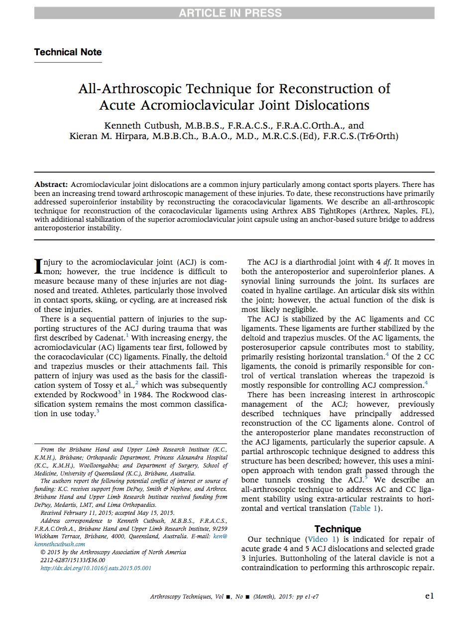 Diagram of arthroscopic acromioclavicular joint reconstruction