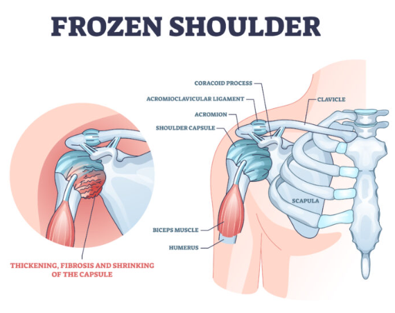 Published article describing the arthroscopic frozen shoulder 360 degree release technique